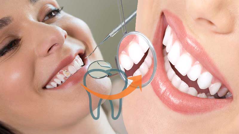 Smile Correction and Smile designing