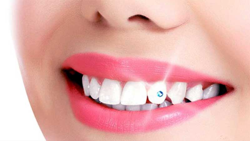 Orthodontic Braces Adhesive - Tooth Gem glue - Light Cure - Permanent Tooth  Gem Flowable Composite for Dentist