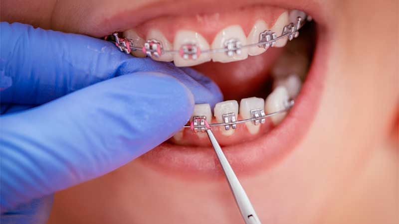 Overbite Correction, Dental Braces