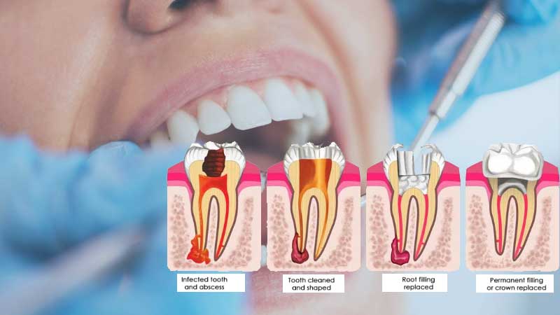 can a root canal be done on a canine tooth